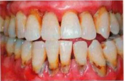 Gambar 2.3 Tanda klinis periodontitis kronis pada pasien usia 45 tahun dengan kesehatan oral yang kurang dan tidak ada perawatan gigi sebelumnya