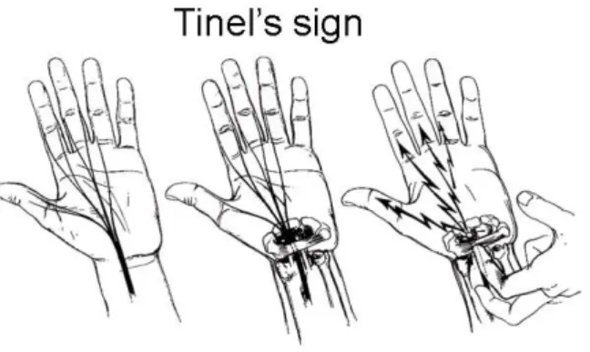 Gambar 2.3 Tinel’s Sign 
