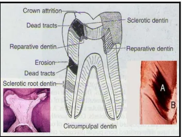 Gambar 6. A. Dentin reparatif; B. Dentin sklerotik 8 