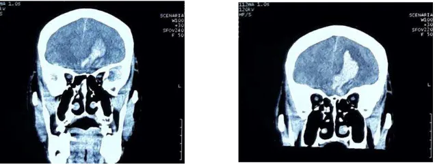 Figure 2. A coronal pre-operative CT scan show multiple contusions at left-right frontal region and enlargement of intracerebral hemorrhage (ICH) at left frontal region