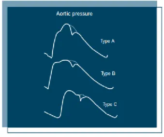 Tabela 2: Tipi aortnega pulznega vala in njegove značilnosti 