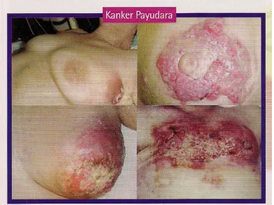 Gambar 2, Kanker Payudara. 