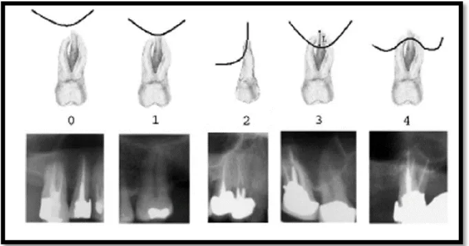 Gambar 7Gambaran klasifikasi gigi geligi maksilari posterior dan .  hubungannya dengan dinding inferior sinus maksilaris menggunakan radiografi panoramik.5 