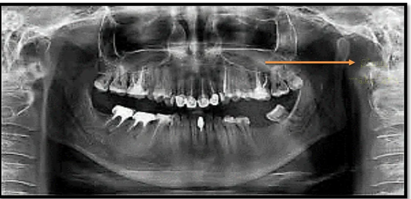 Gambar 4.Gambaran normal sinus maksilaris pada radiografi panoramik.12 