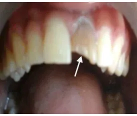 Gambar 2. Foto klinis gigi 21 yang mengalami perubahan warna kecoklat coklatan 