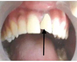 Gambar 7. Gigi 21 Setelah dilakukan bleaching