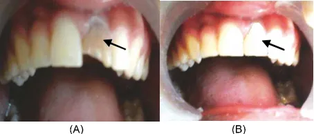Gambar 9. Setelah dilakukan pemasangan  ber dan restorasi resin komposit: (A) Foto sebelum perawatan pada gigi 21; (B) Foto setelah dilakukan perawatan pada gigi 21