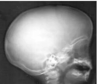 Gambar 2.4 Foto kepala pada anak dengan hidrosefalus.