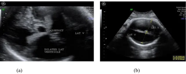 Gambar 2.5 Foto USG kepala fetus pada trimester ketiga. Tampak dilatasi bilateral dari kedua ventrikel lateralis (gambar a) dan penipisan jaringan otak (gambar b).
