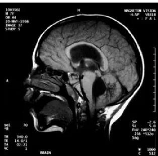Gambar 2.7 MRI potongan sagital pada hidrosefalus nonkomunikans akibat obstruksi pada foramen Luschka dan magendie.