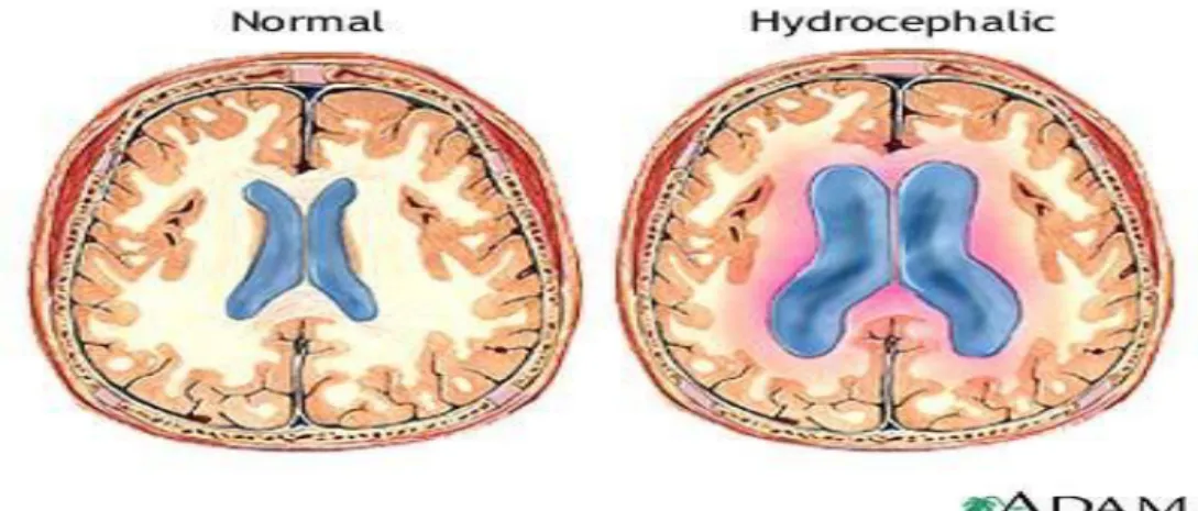 Gambar 2.2 Perbandingan Otak normal dengan Hidrosefalus 2.3 Epidemiologi Hidrosefalus 3