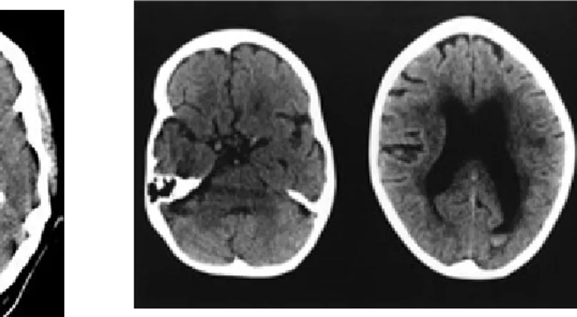 Gambar 2 Gambar CT Scan Perdarahan Subarachnoid