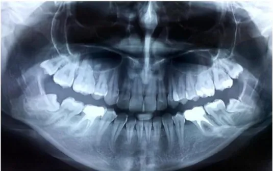 Gambar 6. Bagian CBCT menunjukkan kontak antara akar molar ketiga kanan  mandibula dengan kanal mandibular