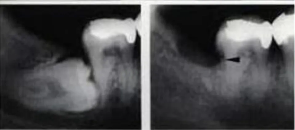 Gambar 7. Gambaran radiografi periapikal pada molar ketiga sebelum dan  sesudah dilakukan pencabutan 