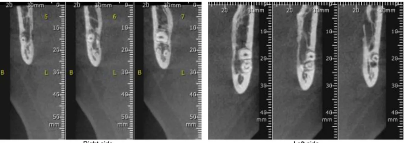 Gambar 2. Bagian CBCT menunjukkan intimate kontak antara  akar molar ketiga mandibula dan kanal mandibular  KASUS 2 