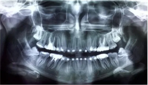 Gambar 3.  Radiografi panoramik dengan tanda-tanda jelas adanya  hubungan dekat antara kedua molar ketiga mandibula dengan kanal 
