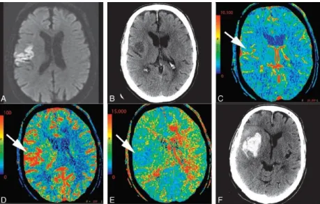 Gambar  12.  Wanita  usia  61  tahun  dengan  kelemahan  sisi  kiri.  CT  scan  otak  tanpa  kontras  menunjukkan  hipodensitas  di  area  yang  divaskularisasi  arteria  cerebri  media  dextra  (panah  putih),  menghilangnya kecekungan sulci, dan hilangny