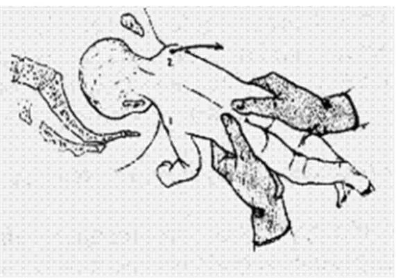 Gambar 2.4 Loveset Manoeuvre  (http://www.google.com)  