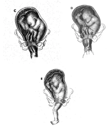 Gambar 2.2 Manuver Pinard  (http://www.google.com) 