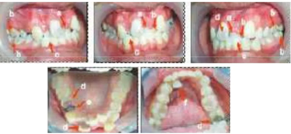 Gambar 3. Foto OPG sebelum perawatan a) Gigi non vital 15, 37, b) Akar gigi 14, 38,   c) Impaksi 48
