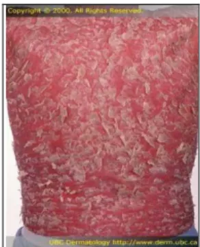 Gambar 7. Psoriasis Eritroderma 