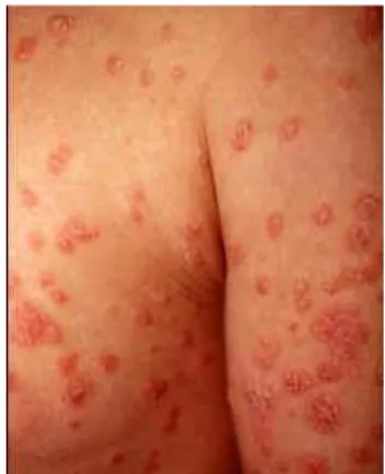 Gambar 4. Psoriasis Gutata 