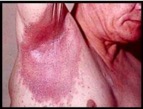 Gambar 6. Psoriasis Pustulosa 