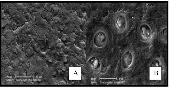 Gambar 1.  A. Kehadiran smear layer pada permukaan pertengahan saluran akar yang diirigasi dengan NaOCl 5,25% dan irigasi final dengan larutan yang sama