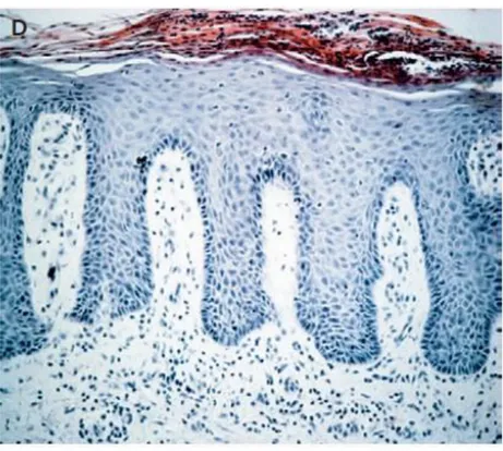 Gambar 2.3 Penebalan Epidermis dan Akumulasi Sel-sel Inflamatori  Sumber: Nestle et al