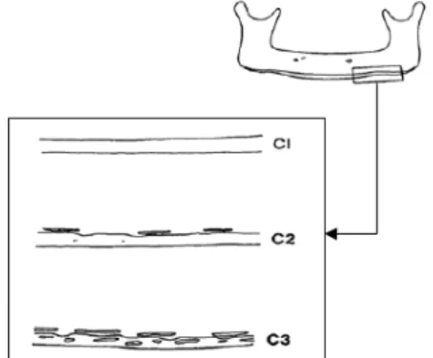 Gambar 2.Gambar ilustrasi klasifikasi endosteal  inferior cortex pada radiografi Panoramik  6   