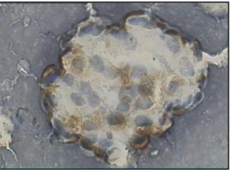 Gambar  3.a.b.  Kasus  No  40.  Klaster  sel  mesotel   reaktif, Calretinin (+) kuat dan sedang, 400x 
