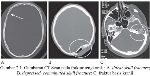 Gambar 2.1. Gambaran CT Scan pada fraktur tengkorak : A. linear skull fracture;  B. depressed, comminuted skull fracture; C