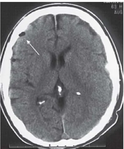 Gambar 2.2. Gambaran CT Scan kepala yang menunjukkan adanya udara pada  intrakranial 