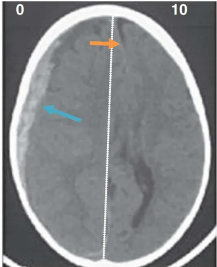 Gambar 2.4. Perdarahan subdural (biru) dengan pergeseran garis sutura (oranye)  Sumber : Andrew D