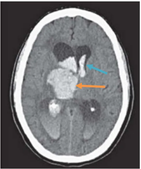 Gambar 2.6. Perdarahan intraparenkim (oranye) disertai dengan perdarahan  intraventrikular (biru) 