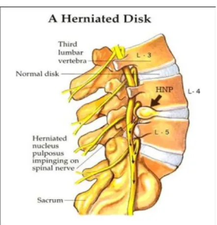 Gambar 6.  Ilustrasi radiks nervi spinalis dan herniasi nukleus pulposus 