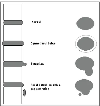 Gambar  9.  Ilustrasi  sederhana diskus normal , bulging disk,  ekstrusio                      diskus  dan  sequestrasi