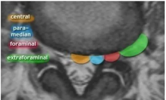    Gambar 10. Ilustrasi MRI axial lokasi herniasi diskus.(Lee and Choi,2009)              Berdasarkan lokasi,  herniasi diskus dibagi 4 (Kim, 1999) yaitu :  