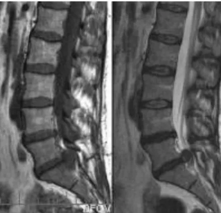 Gambar 17. MRI L5 radikulopathy.   Potongan   Sagittal    T1- dan   T2WI                      menunjukkan gambaran  ekstrusi diskus central di  L4-5                      kanan pada  marked yang compresi  thecal sac