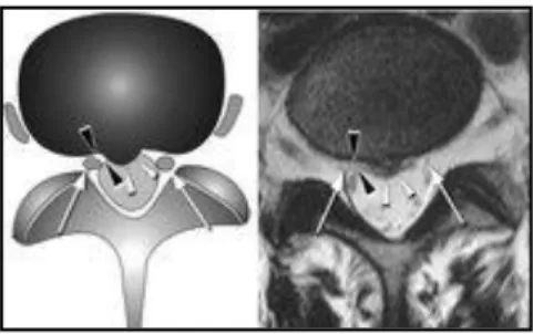 Gambar 18. Diagram (kiri)  Lapisan  lemak  epidural  yang  normal                       (panah   hitam)   terlihat antara radiks saraf ( panah                       hitam) dan  diskus  (panah putih)