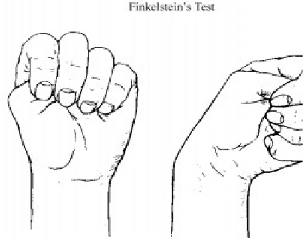 Gambar 6. Finkelstein test b. Pemeriksaan Radiologis