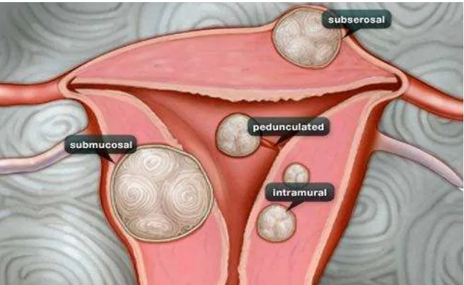 Gambar 1. Anatomi Uterus Normal 