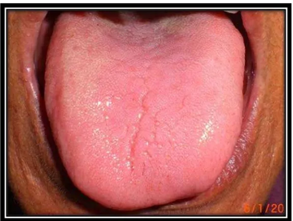 Gambar 10. Glossitis Tuberkulosa pada penderita TB29 