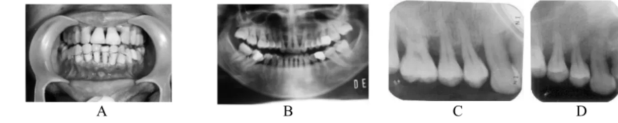Gambar 1. Kasus I.Seorang pasien wanita, 32 tahun. Keluhan goyang pada gigi-giginya. 