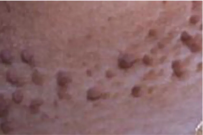 Gambar 2.1 Skin tag yang multipel (Allegue, et al., 2008) 