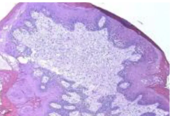 Gambar 2.2 Gambaran histopatologi skin tag (Weedon, 2010) 