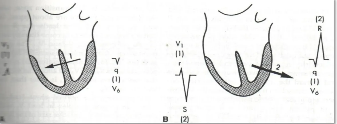 Gambar 2.1  Fase –fase depolarisasi ventrikel yang  normal (Goldberger, 1998) 