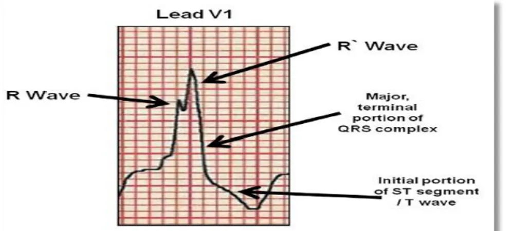 Gambar 2.3. Bentuk Klasik Rabbit Ears pada RBBB pada EKG dengan gambaran   kompleks RSR’ (Horton dkk , 2009)