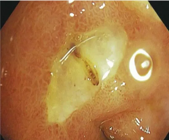 Gambar 2.1.   Gambaran endoskopi pada pasien gastric ulcer akibat penggunaan  NSAIDs dan test H.Pylori negatif  (Vakil, N., 2010) 