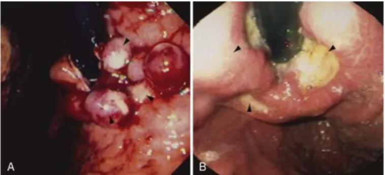 Gambar 2.5.   Gambaran endoskopi dari gastric varices dan esophageal variceal  ligation-related ulcers  (Shah, V.H., et al., 2010) 